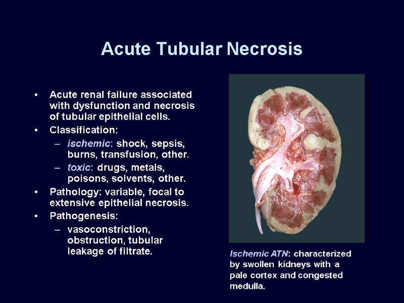 Acute Tubular Necrosis Acute renal failure associated with dysfunction and necrosis of tubular epithelial